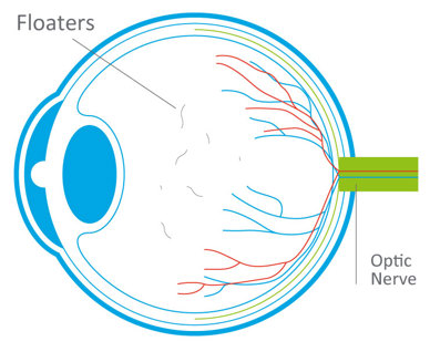FloatersDiagram.jpg