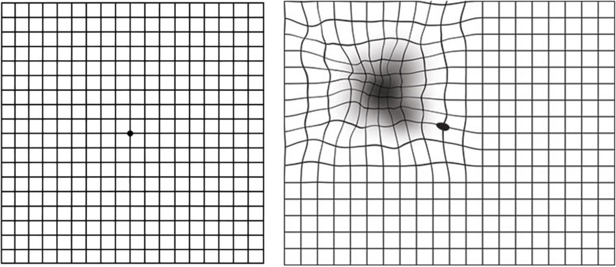Amsler Grid Examples